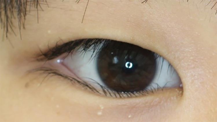 さいたま市中央区の形成外科｜与野本町形成外科｜逆さまつげ