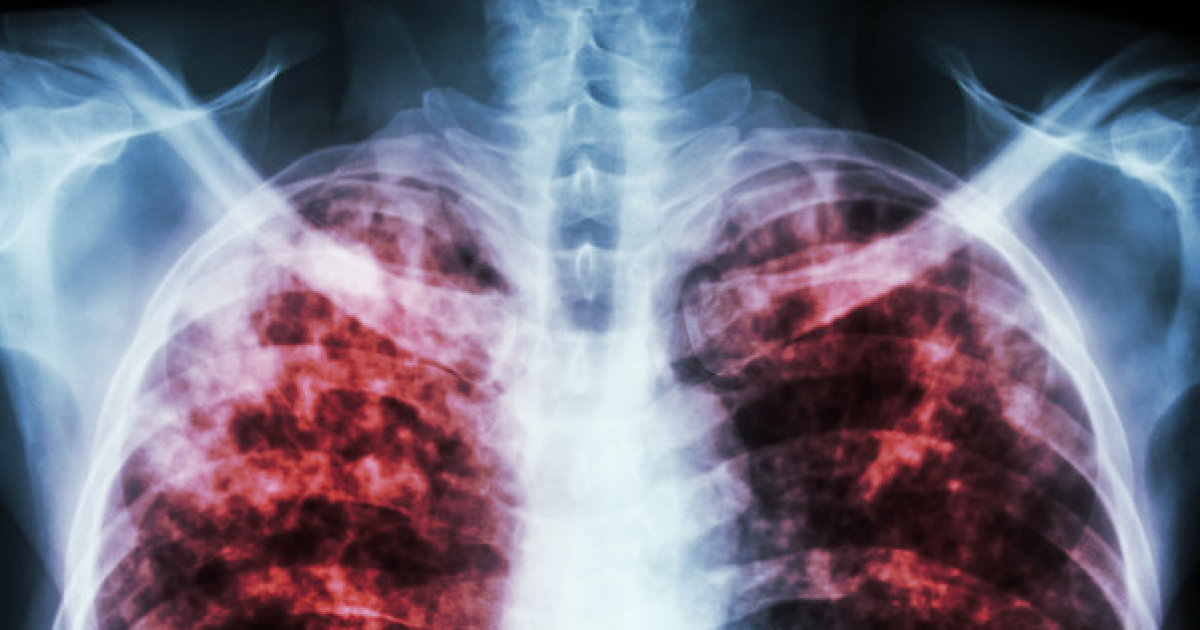 10 Of The World Most Deadliest Diseases Of All Time
