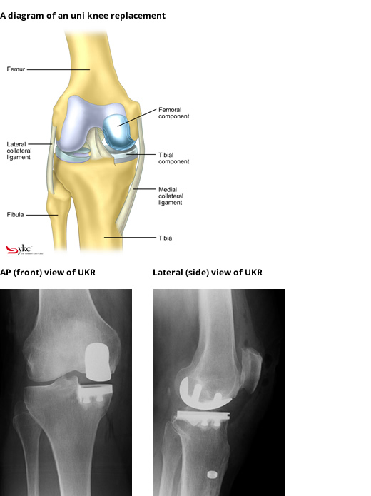 When is it time for a knee replacement? Orthopaedics and Rehab.