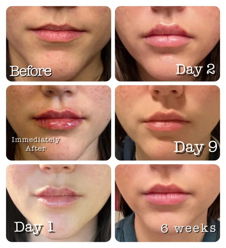 How Long Does 0.5 mL Lip Filler Last?