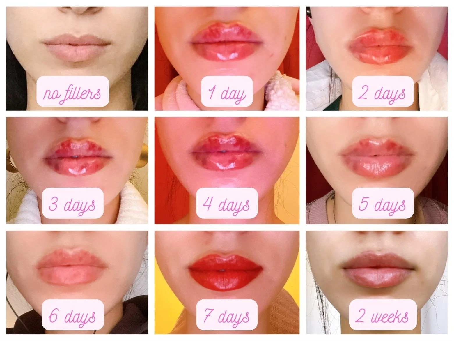 Lip Filler Healing Process Day by Day Yorkshire Skin Centre