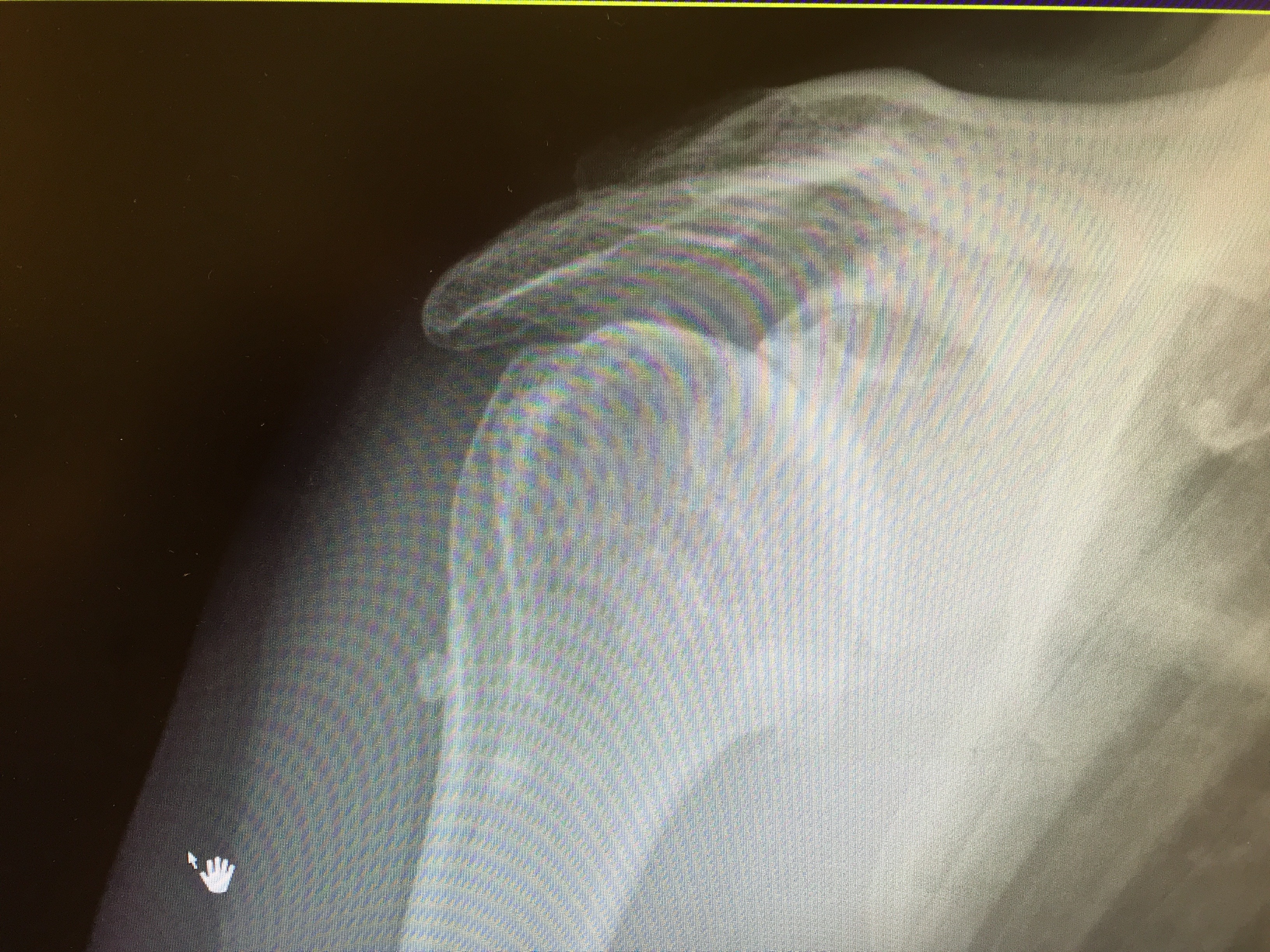 Shoulder Arthritis York Shoulder Clinic