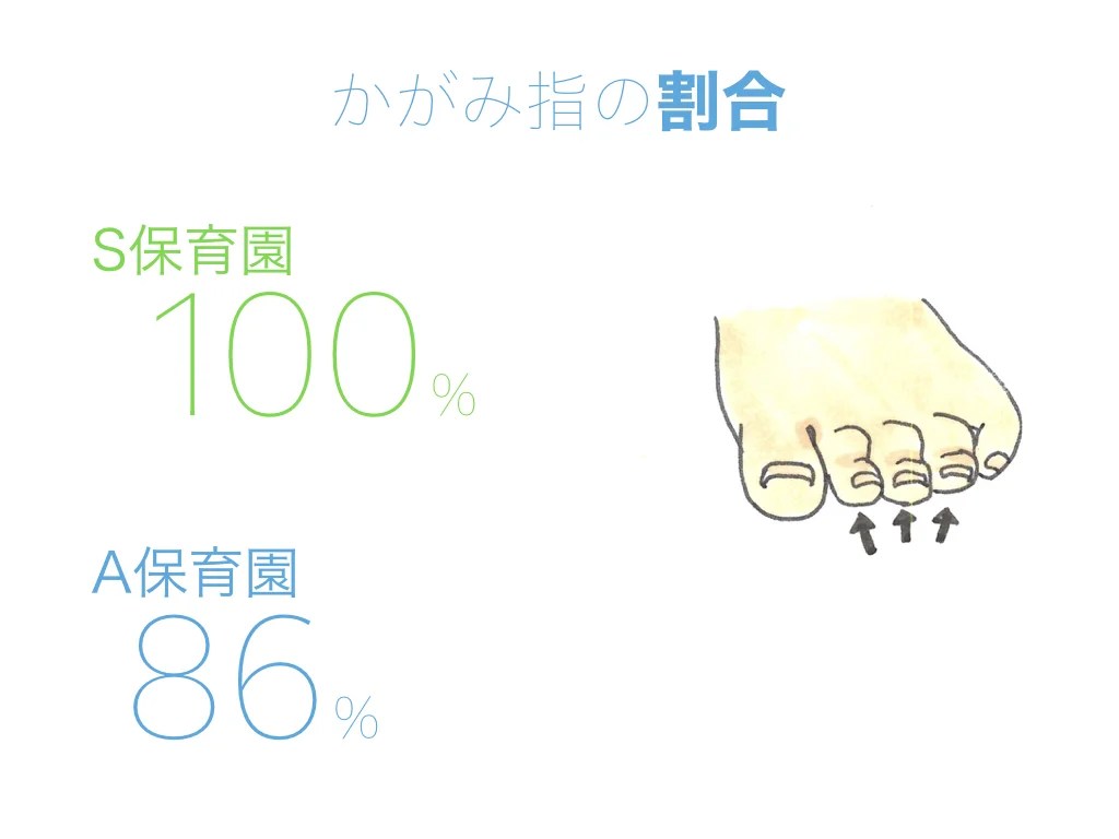 かがみ指の治し方｜足指体操と魔法のくつ下の驚くべき効果 | 足指研究所 かがみ指の治し方｜足指体操と魔法のくつ下の驚くべき効果 | 足指研究所