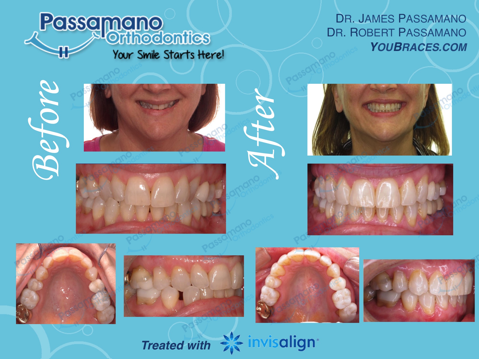 Invisalign Before and After Passamano Orthodontics