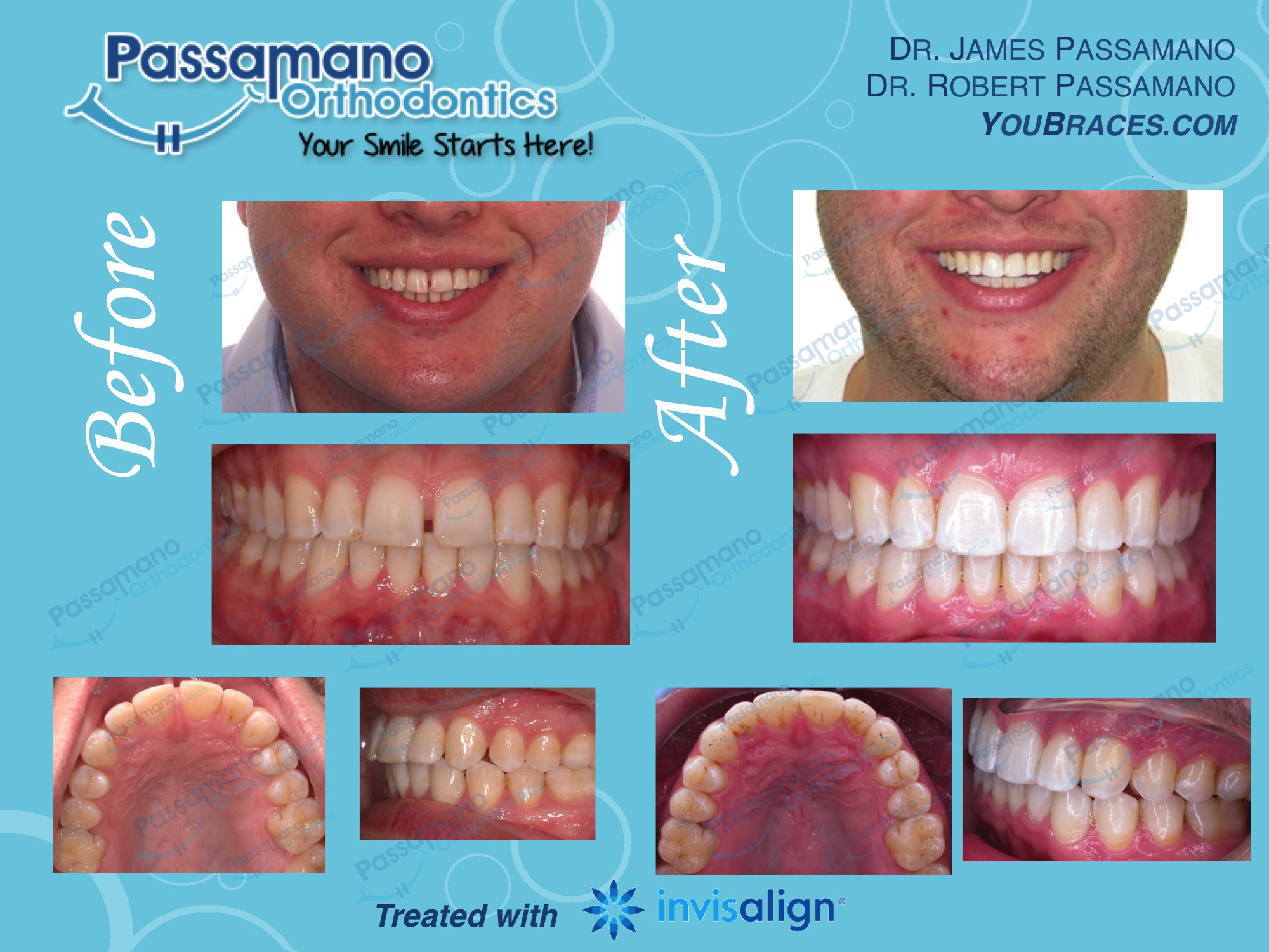 Closing gap : Invisalign