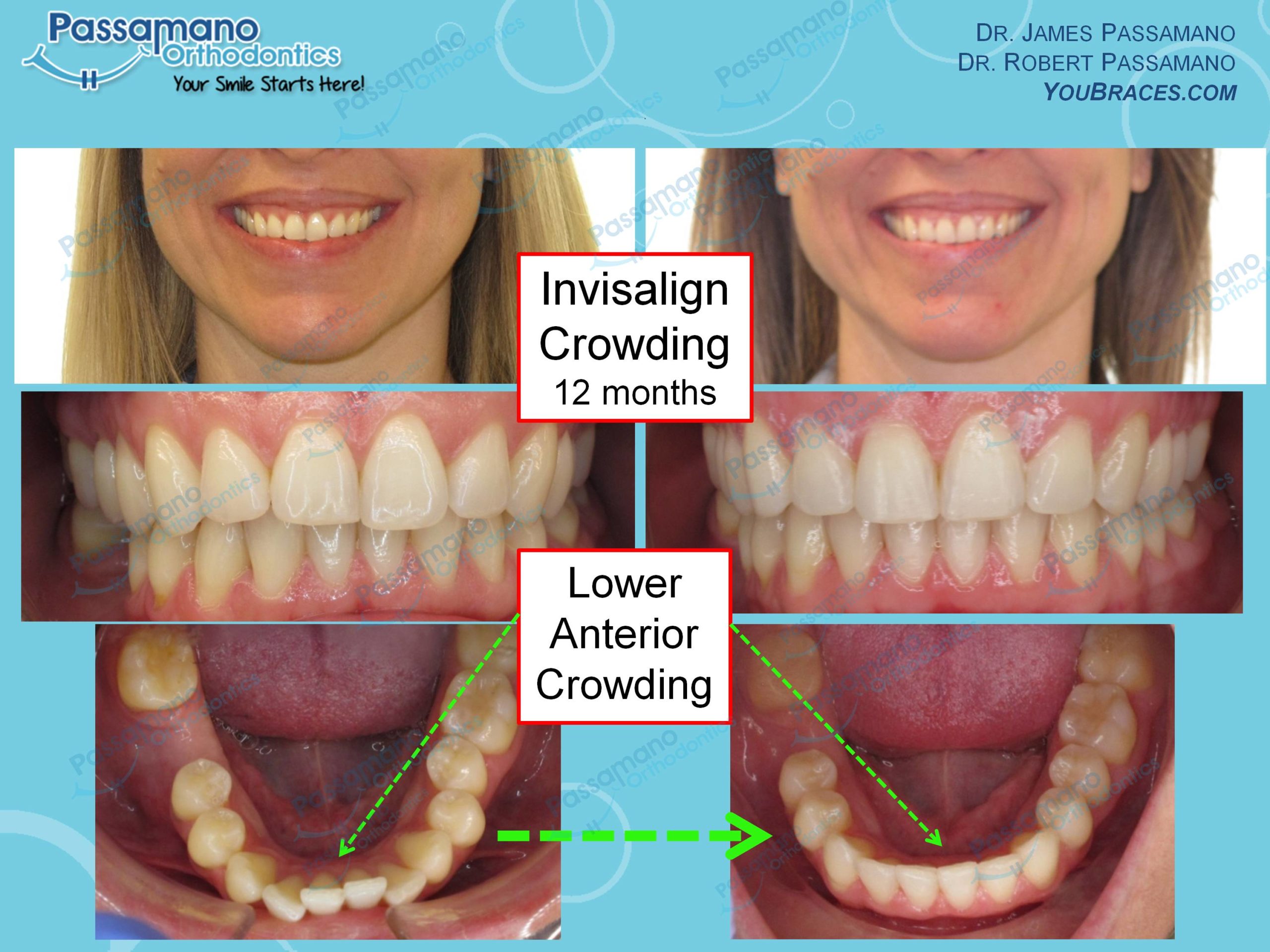Braces & Invisalign Smile Gallery Passamano Orthodontics Irvine CA