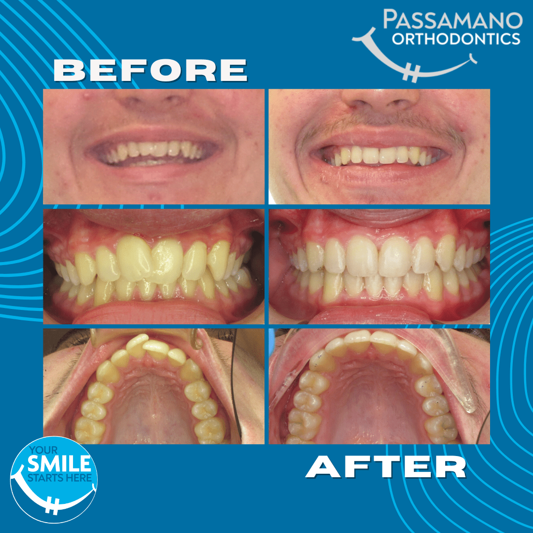 Custom Digital Braces Passamano Orthodontics