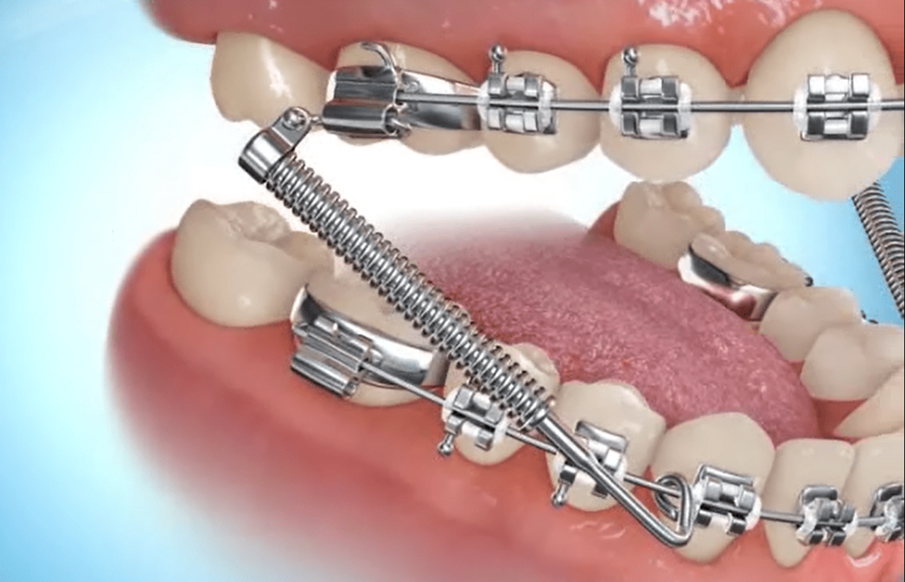 Forsus Springs A Patient's Guide Premier Orthodontics