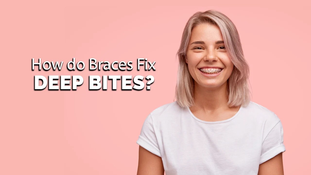How Do Braces Fix Deep Bites? Premier Orthodontics