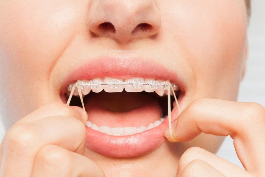 How to Put Rubber Bands On Braces Premier Orthodontics