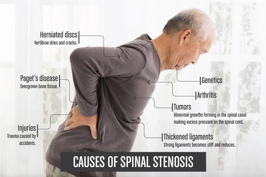 Benefits of Inversion Therapy for Spinal Stenosis Your Body Posture