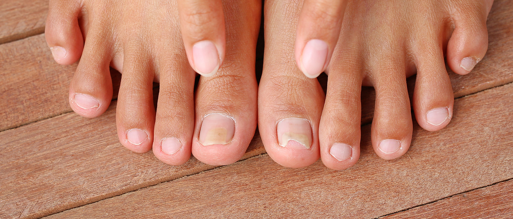 Toenail Fungus Treatment in Chicago Advanced Foot & Ankle Centers of