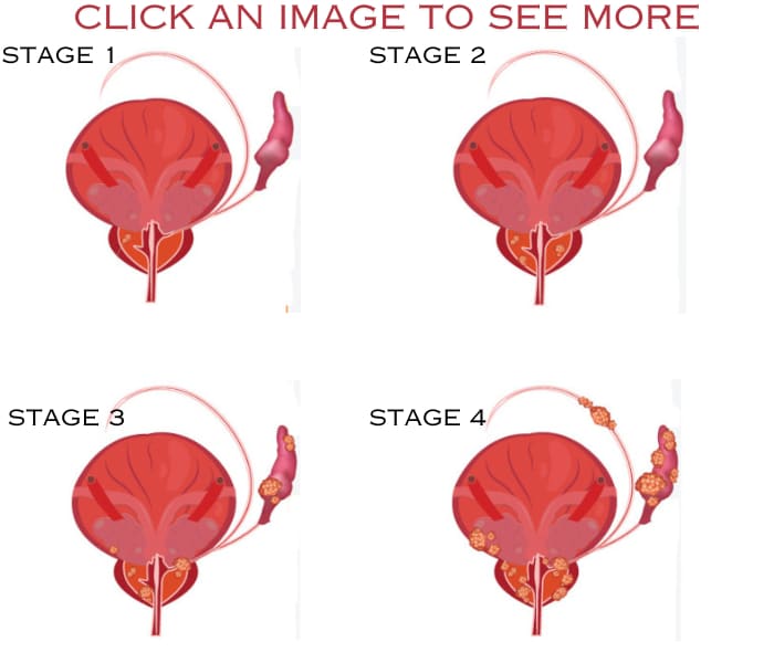 Mastering Prostate Cancer Staging