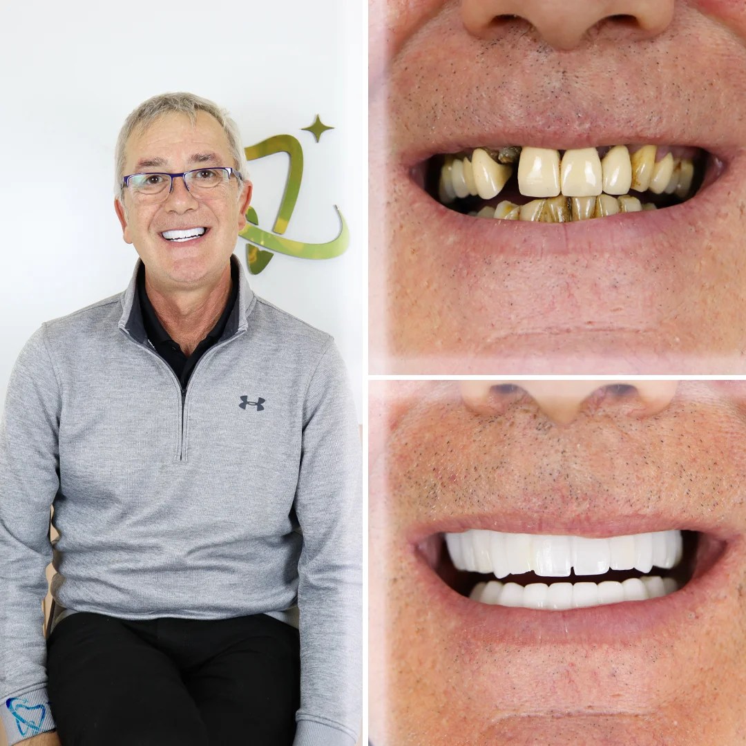 Before and After Photos Your Smile Turkey Dental Clinic