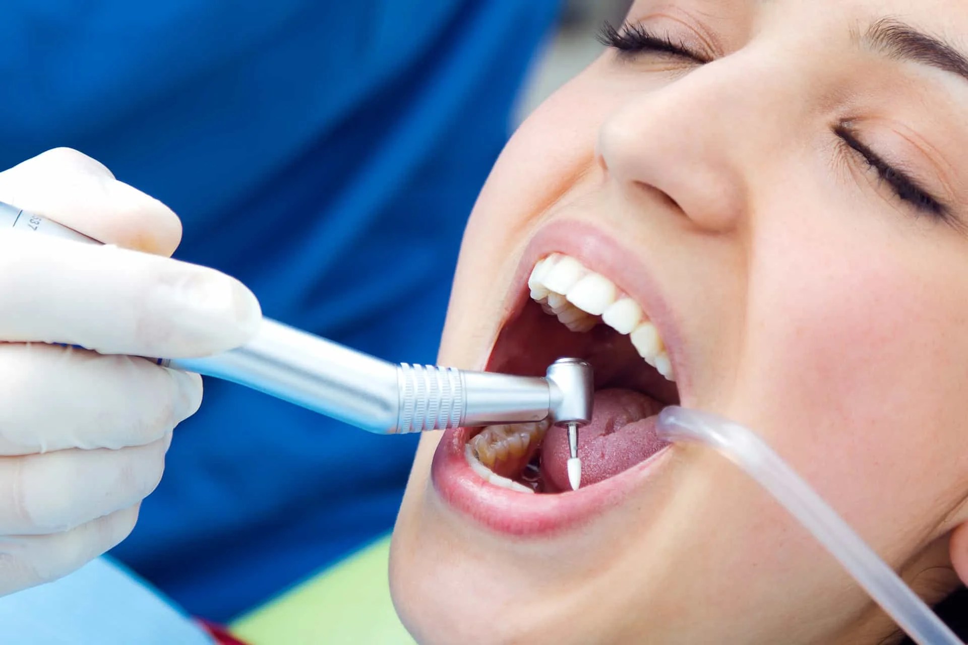 Composite Bonding in Turkey Your Smile Turkey Dental Clinic