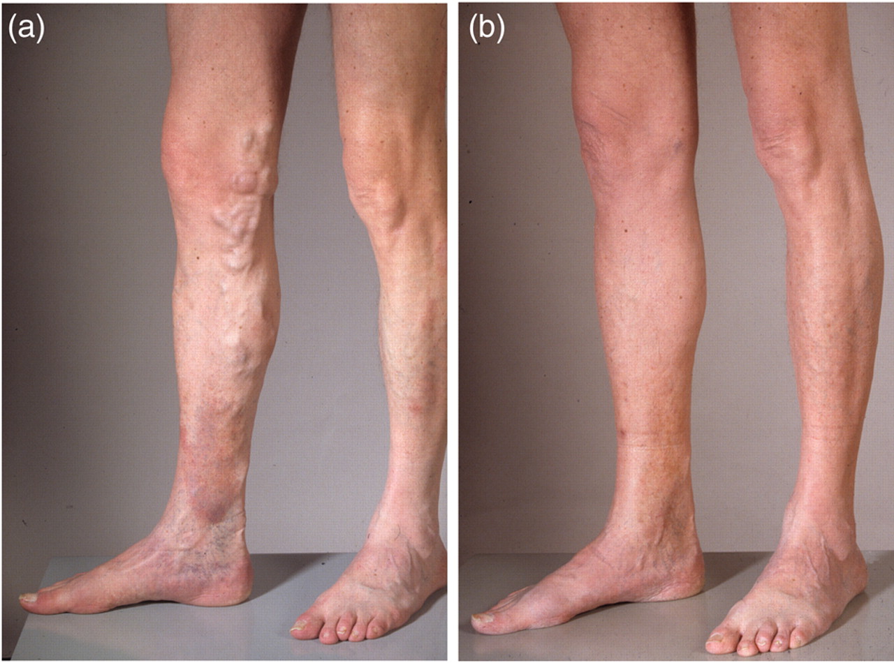 Chicago Vein Care Center Wants You to Know the Unexpected Side Effects