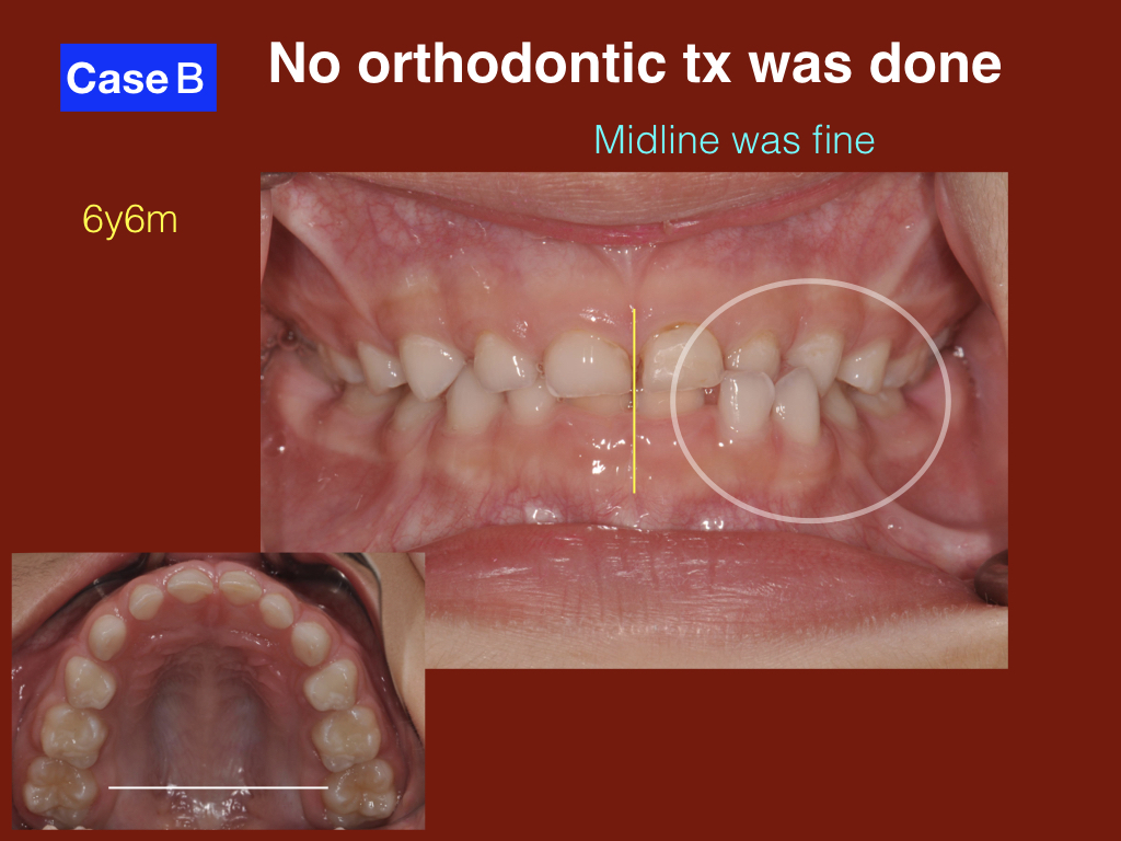 Unilateral posterior crossbite in primary dentition Advanced