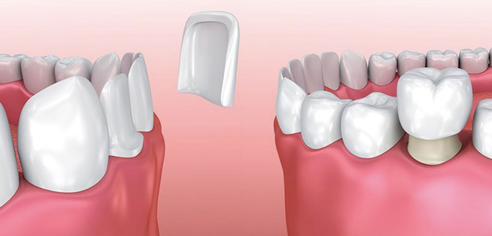 Veneers Strahlend weiße Zähne & ein ästhetisches Lächeln