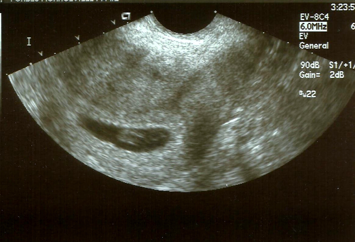 What is a miscarriage? Zambian Eye