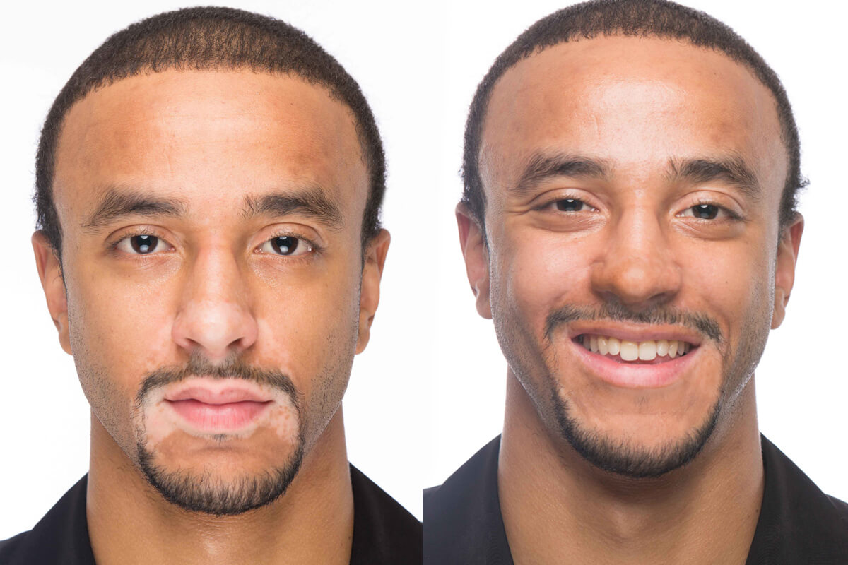 Vitiligo Makeup Before And After Saubhaya Makeup