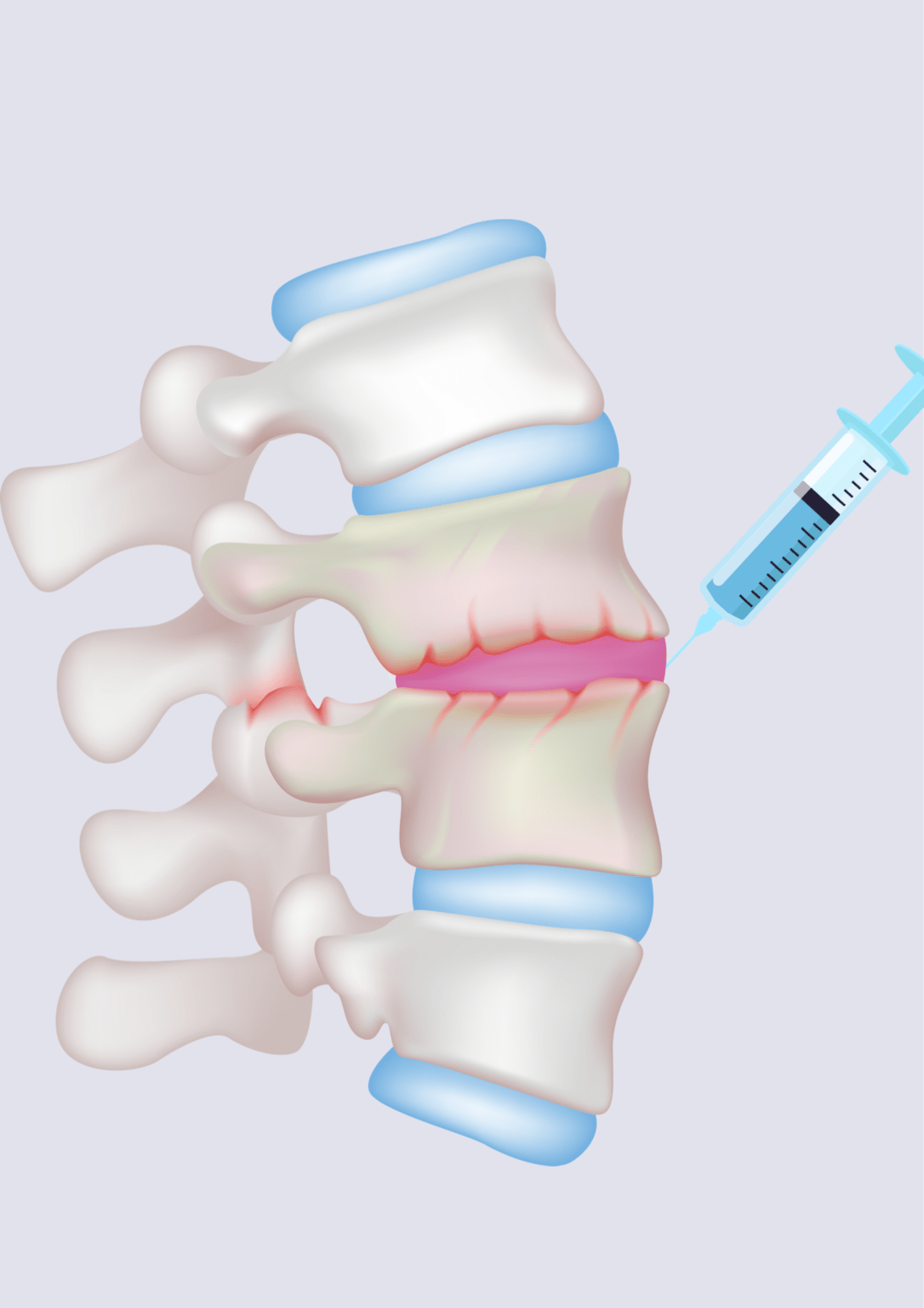 Will A Spinal Injection Take Away the Pain? Zang Physical Therapy