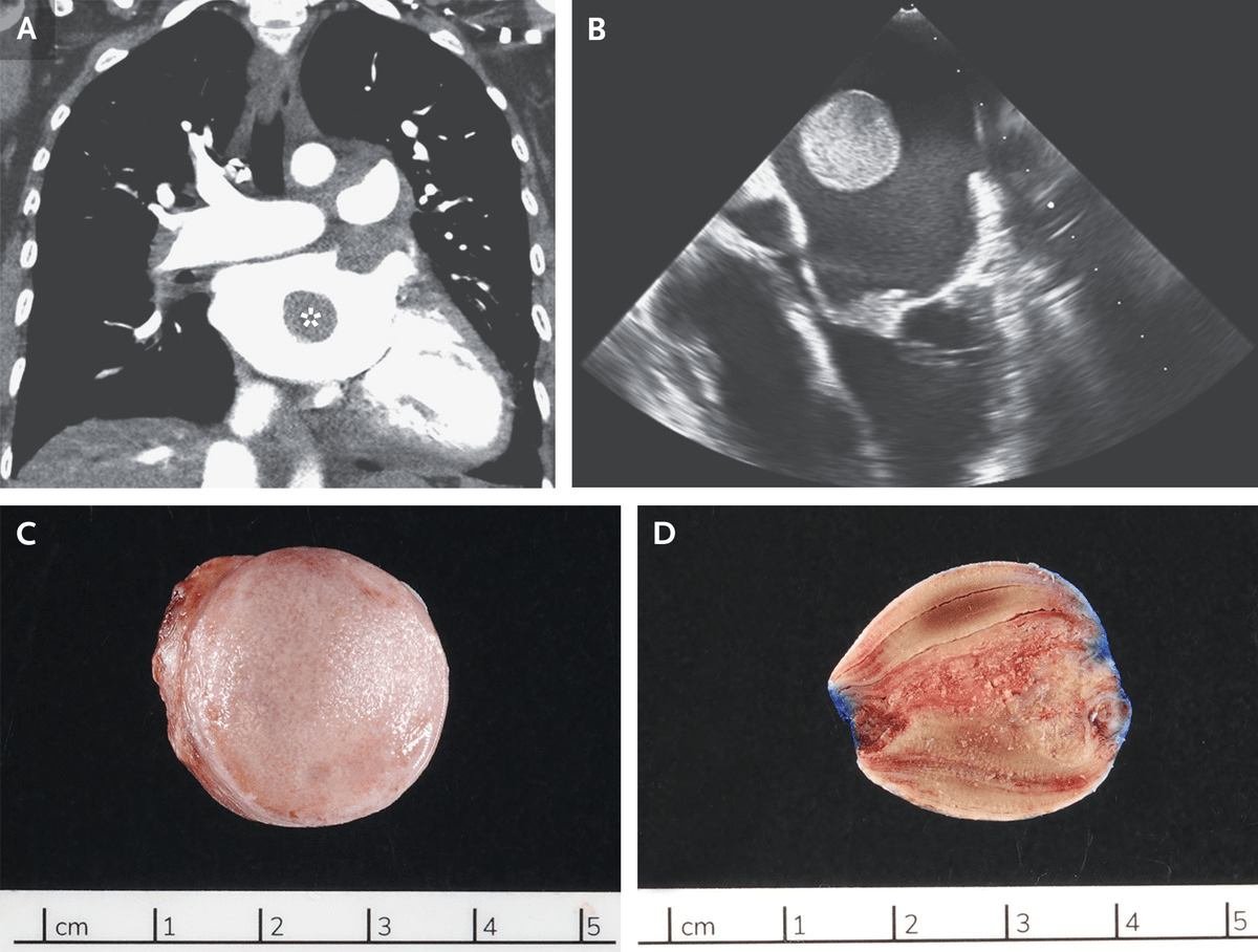 Left Atrial Thrombus | SOMEONE SOMEWHERE