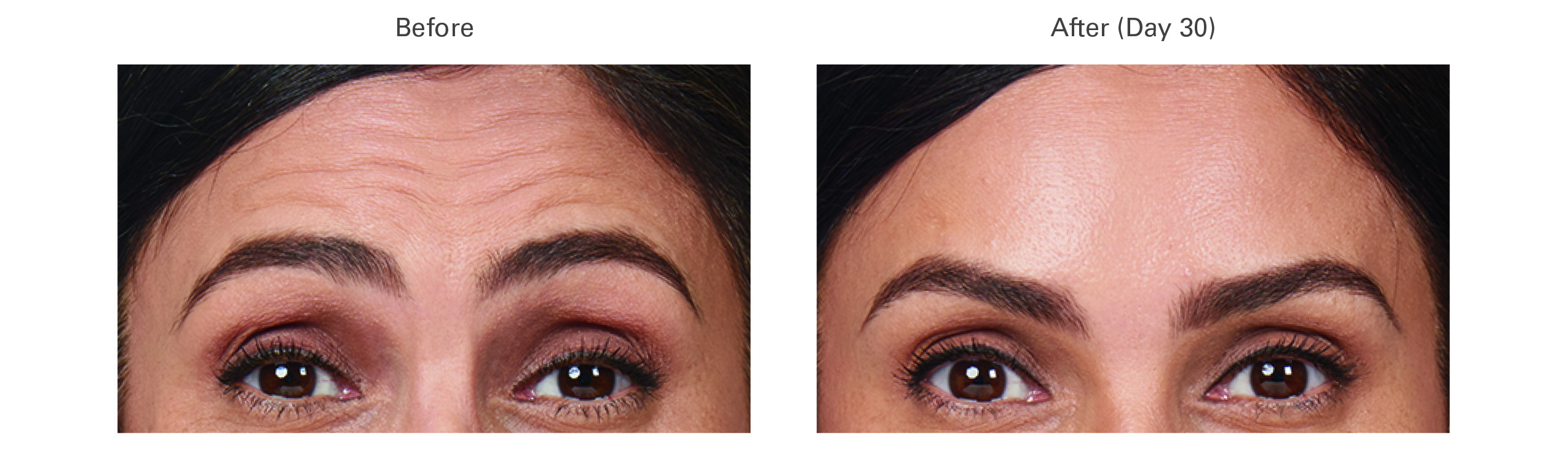 Botox Treatments in Las Vegas, Nevada Zenestar Aesthetics Medical