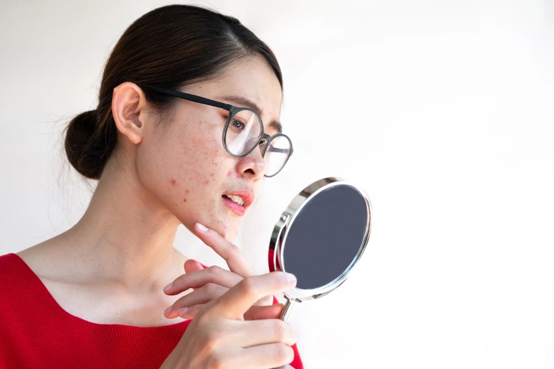 Acne and Acne Scars Zest Clinic Skinboosters Fillers ED