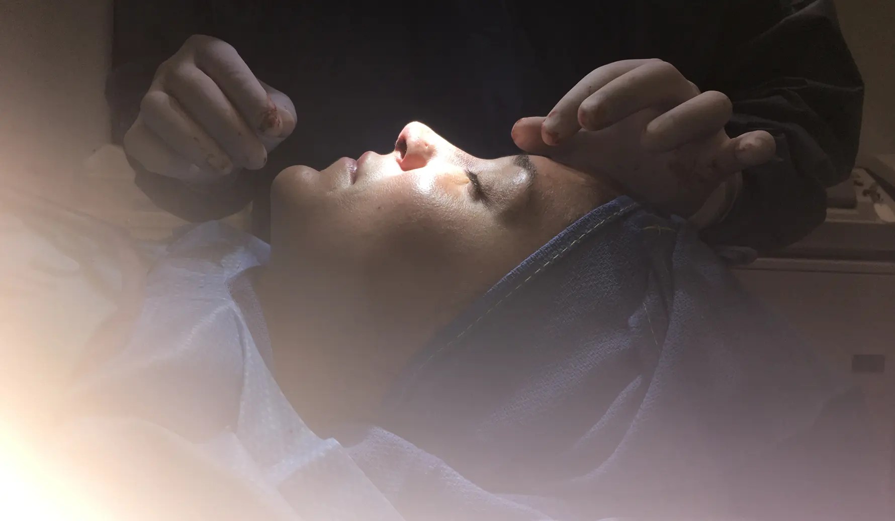 Best Rhinoplasty in Miami Z Facial Plastic Surgery