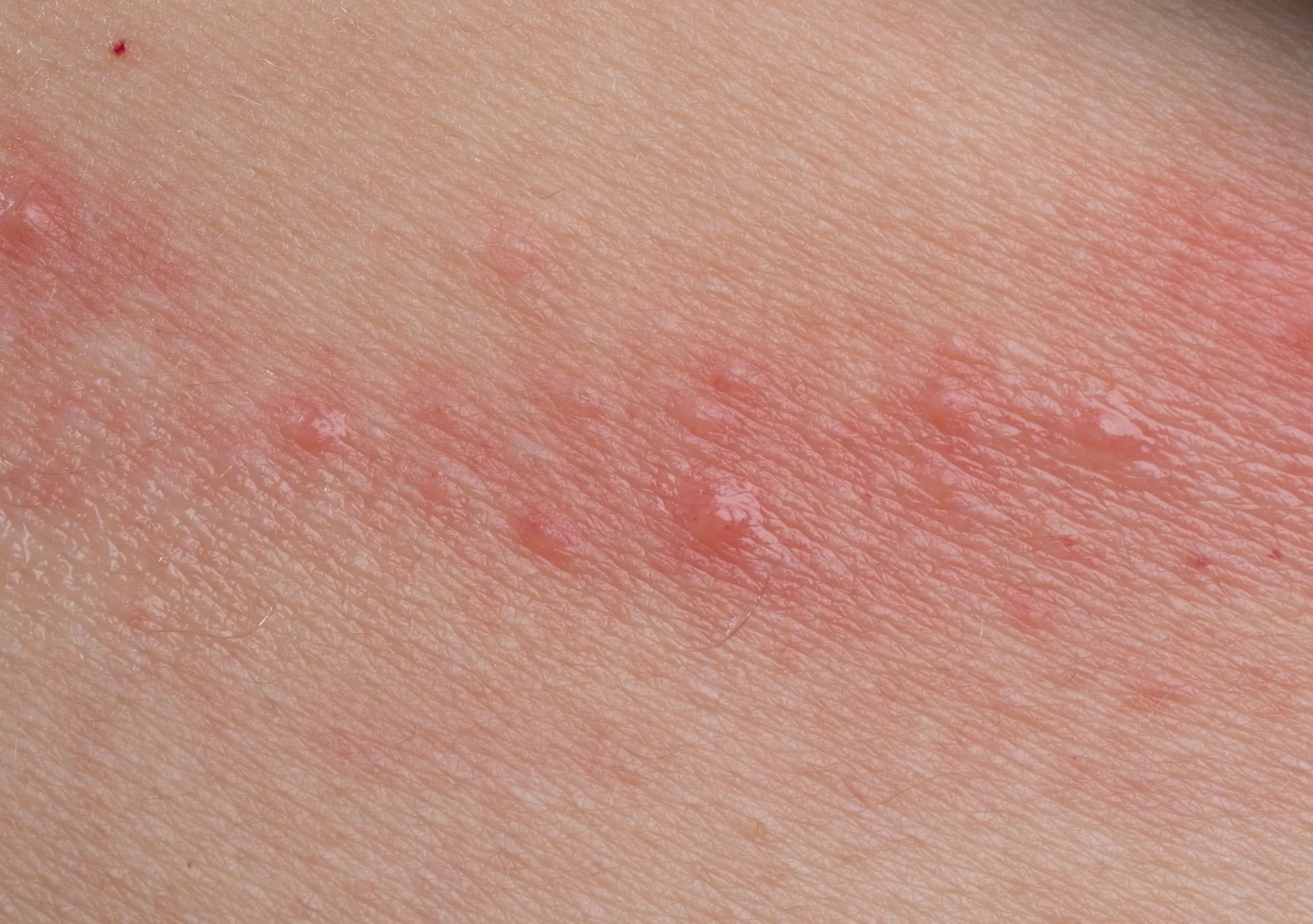 Shoe Contact Dermatitis Cure at Harold Hatch blog