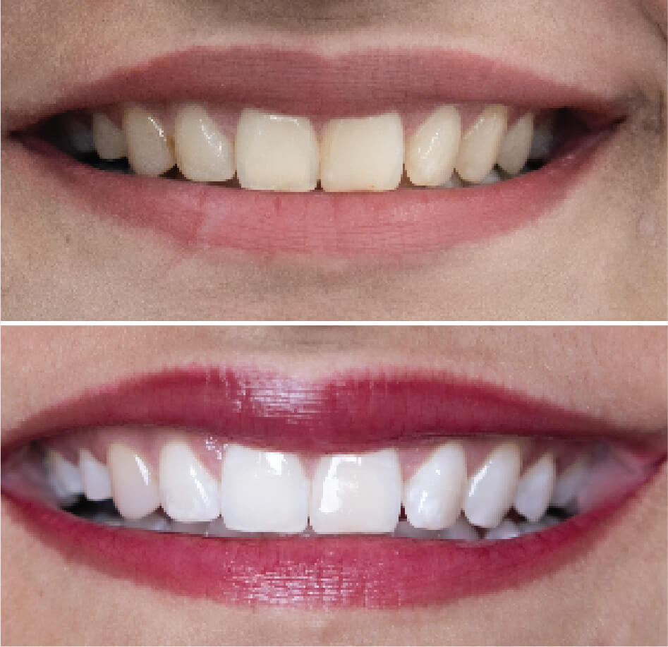 Dental Crowns Zieda’s Aesthetic Clinic