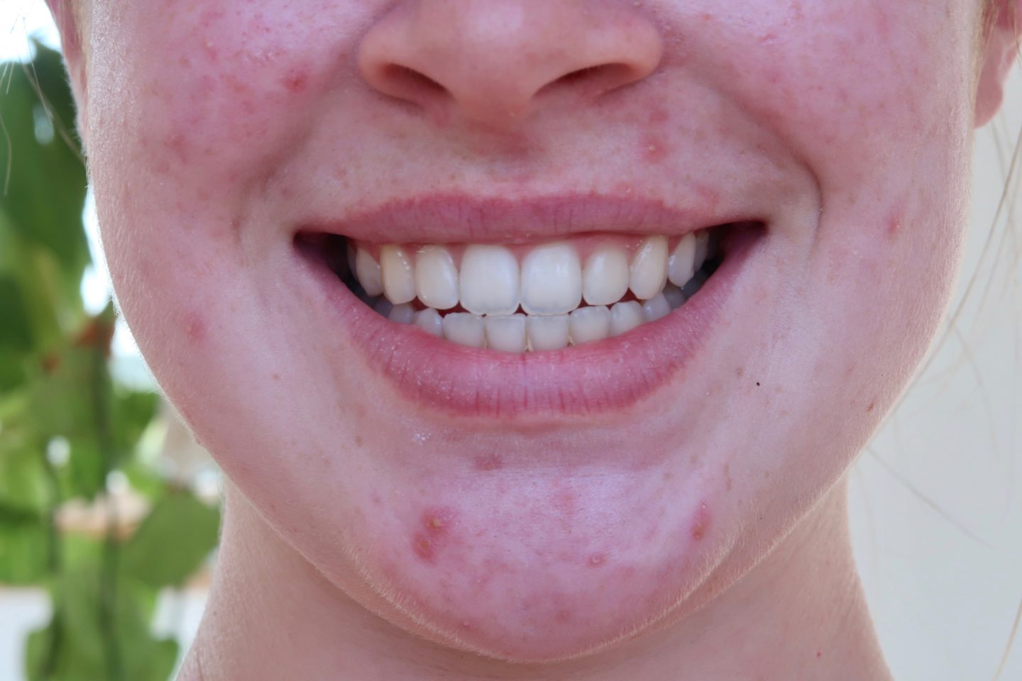 The Best Teeth Whitening Strips AD Zoë Ware the best