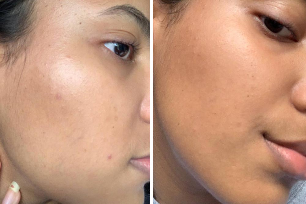 5 Girls Tried La RochePosay's Effaclar Serum To See If They Could Get