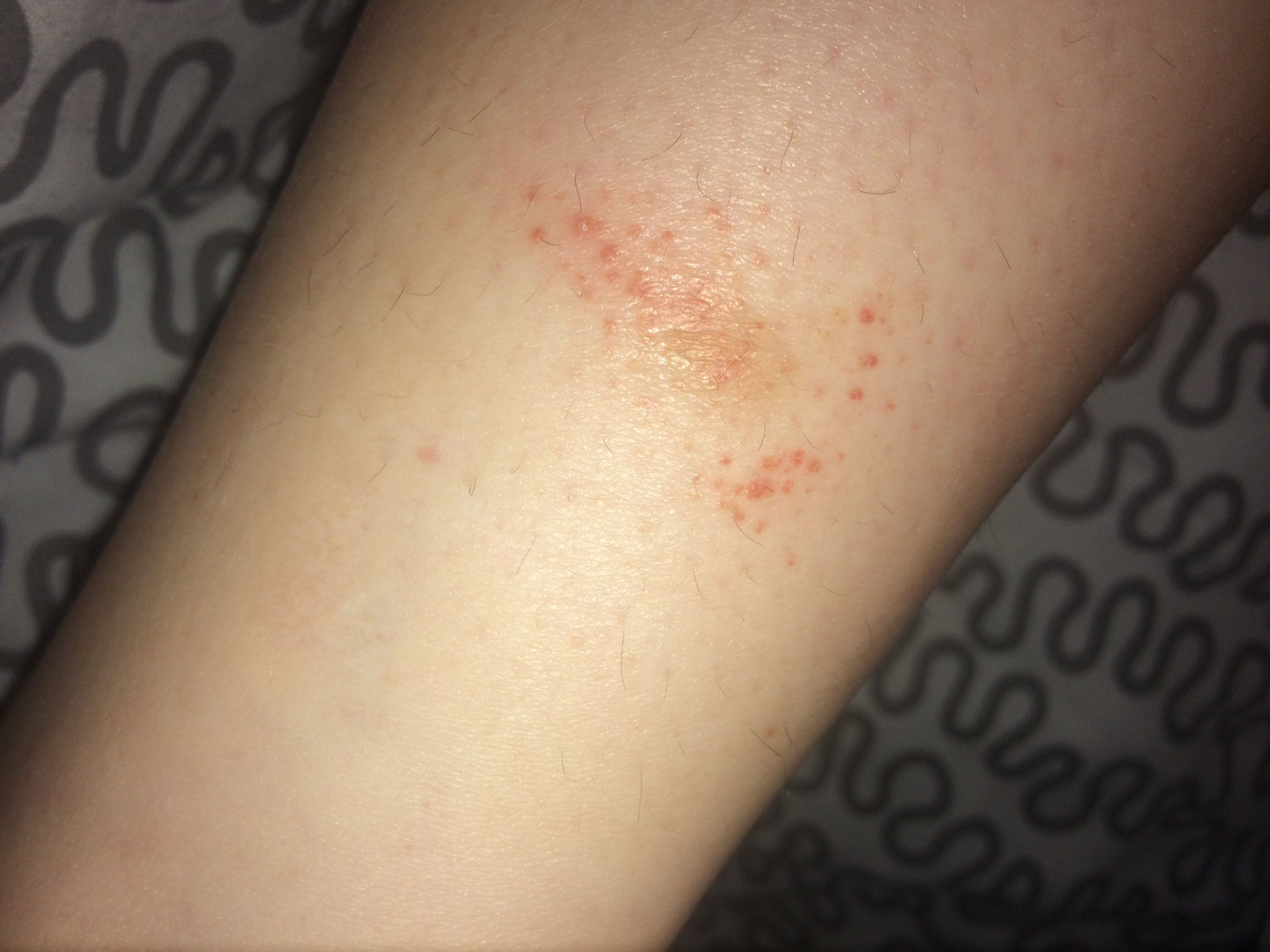 Petites Tâches rouges sur les jambes Acné, psoriasis et problèmes de